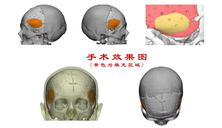林志颖车祸致颜面骨折，医生：评估后或进行脸部3D重建