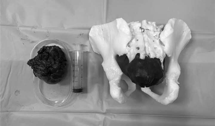 3D打印技術賦能，煙臺山醫(yī)院完成一例骶骨巨大惡性腫瘤手術