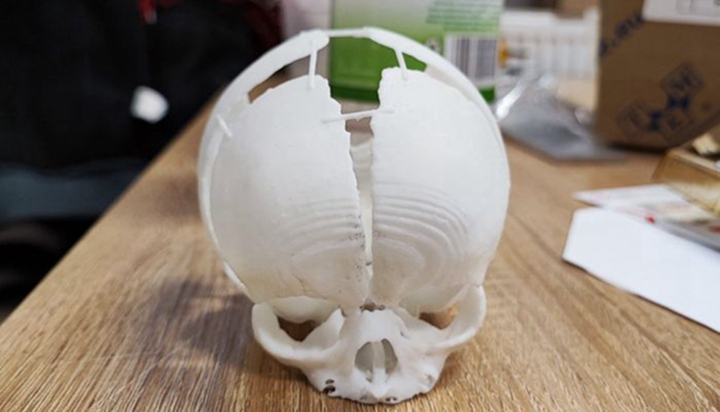 3D打印帮助拯救有颅骨缺陷的新生儿