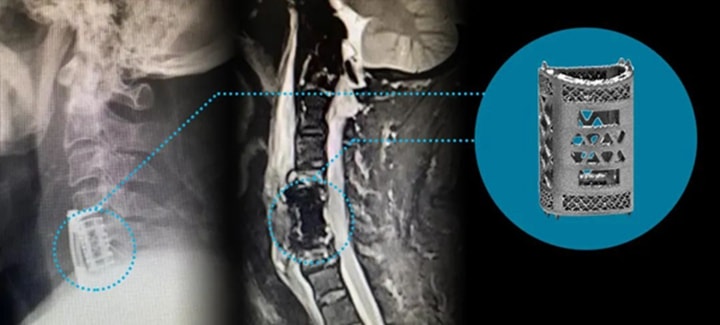 3D打印多孔型椎體融合器成功應用于頸椎前路椎體次全切手術(shù)