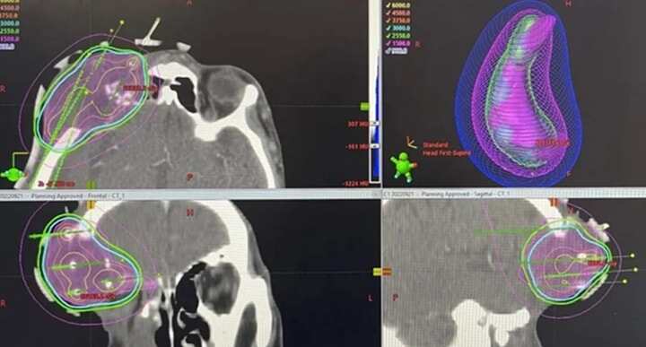 3D打印非共面模版引導(dǎo)下的插植放療頭頸部復(fù)發(fā)腫瘤