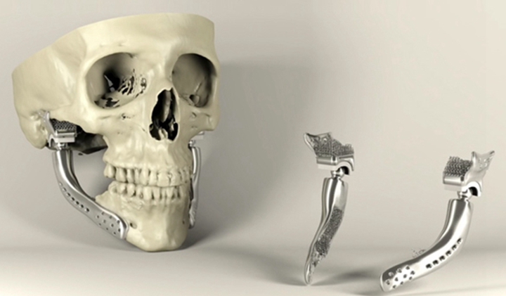 3D打印助力完成假体踝关节部分置换术