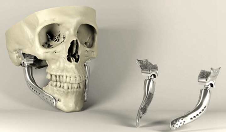 3D打印助力完成假體踝關(guān)節(jié)部分置換術(shù)