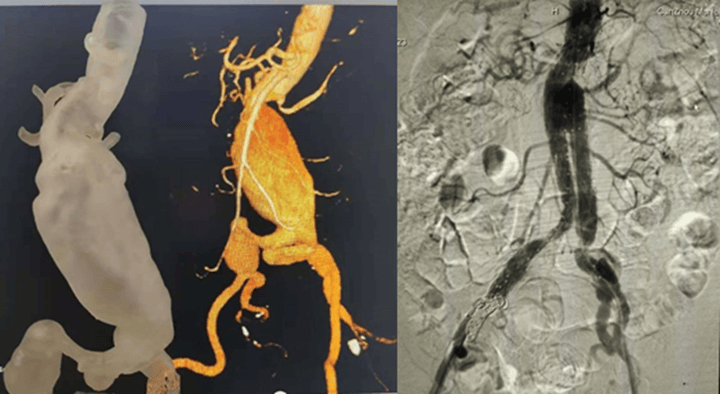 案例解析：3D打印輔助腹主動(dòng)脈瘤覆膜支架腔內(nèi)隔絕術(shù)