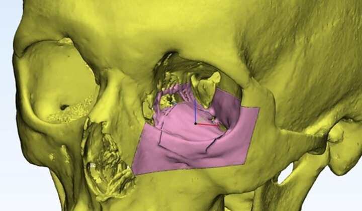 阿聯(lián)酋利用3D打印技術(shù)重建患者的眼窩
