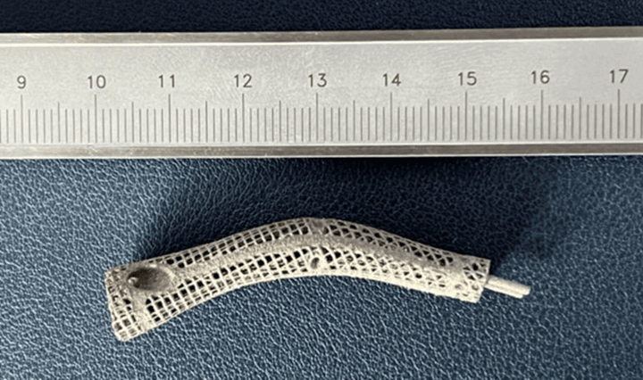 3D打印鈦合金假體，治療手指骨缺損