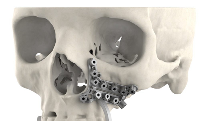 癌症患者利用3D打印技术，在手臂上长出新鼻子并移植成功