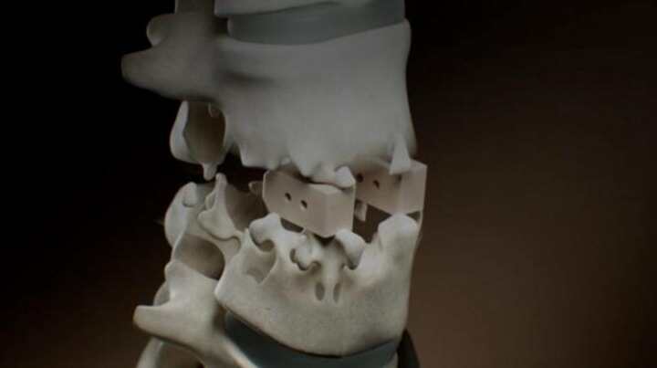 從3D可打印個性化PEEK脊柱融合器看硬組織植入物新發(fā)展趨勢
