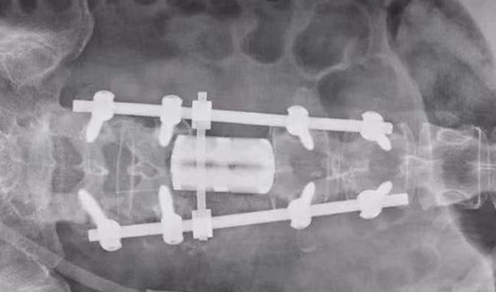 新疆医科大学第三临床医学院完成3D打印人工椎体置换手术 - 图片