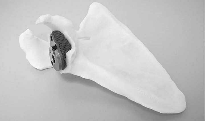 Materialise與Exactech合作，研發(fā)更多3D打印植入物