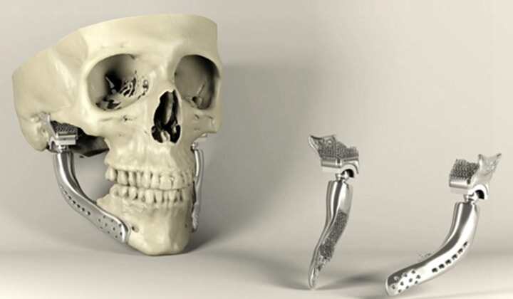 3D打印骨科應用在國內已普遍化