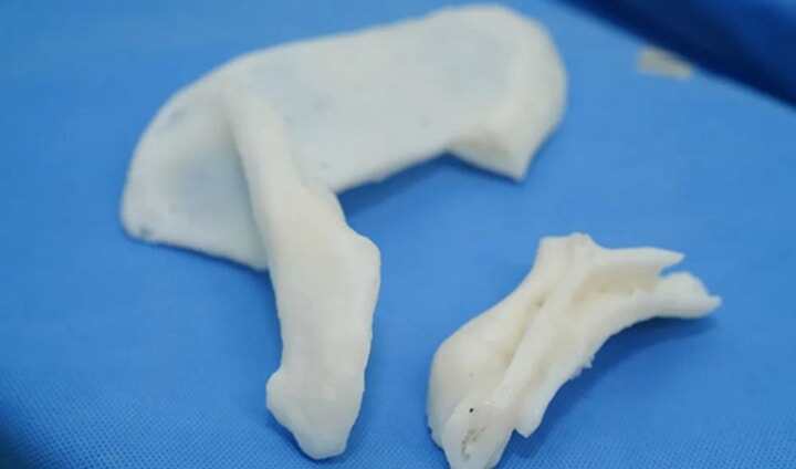 3D打印反肩置換，解決患者疑難復(fù)雜肩關(guān)節(jié)陳舊毀損傷難題