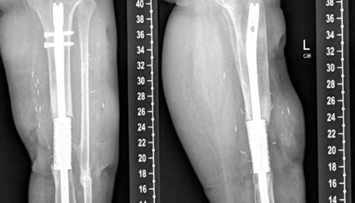 3D打印定制鈦合金網(wǎng)籠成功治療因感染難以愈合的骨結(jié)構(gòu)