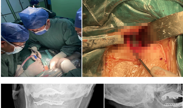 脊柱外科3D打印技术取得重要突破