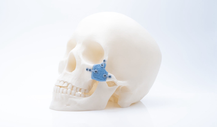 美國推出首個商用3D 打印多孔PEEK脊柱植入物，植入手術已獲成功 - 圖片