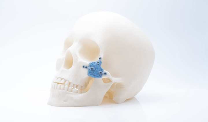 美國推出首個商用3D 打印多孔PEEK脊柱植入物，植入手術(shù)已獲成功