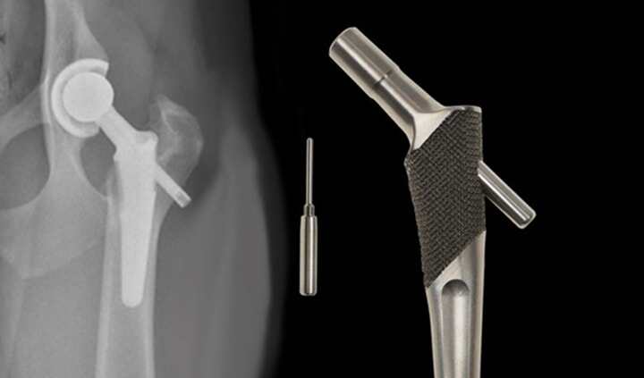 EBM技術(shù)：醫(yī)療3D打印植入物的未來
