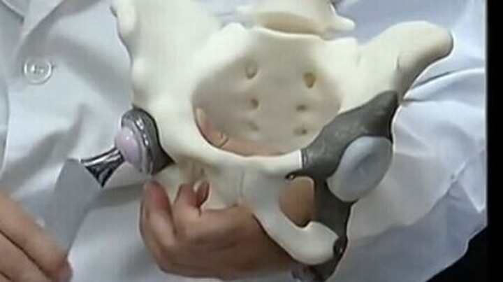 3D打印個(gè)體化定制假體治療復(fù)雜髖關(guān)節(jié)翻修術(shù)成功實(shí)施