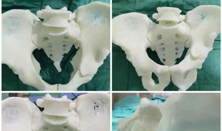 3D打印助力微創治療骨盆骨折 - 圖片