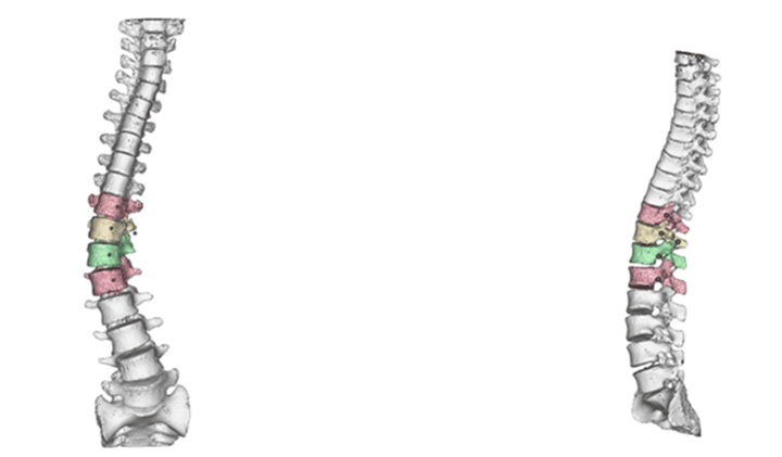 3D打印在脊柱外科中的應(yīng)用