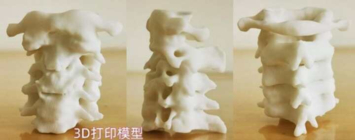 3D打印技術助力高風險寰樞椎手術圓滿完成