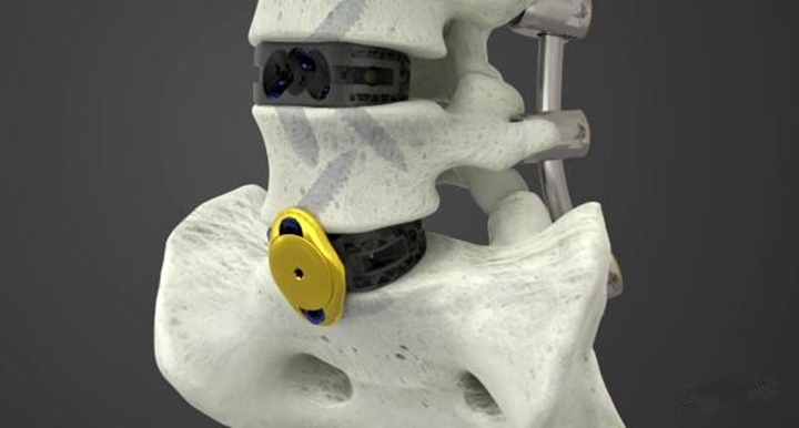 骨科巨头全面推出3D打印产品