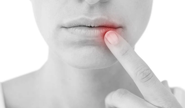 3D打印的人體皮膚類似物有助于確定潛在的皰疹治療方法