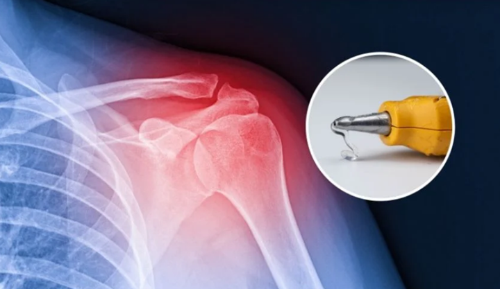 利用3D打印技術(shù)修復(fù)骨骼