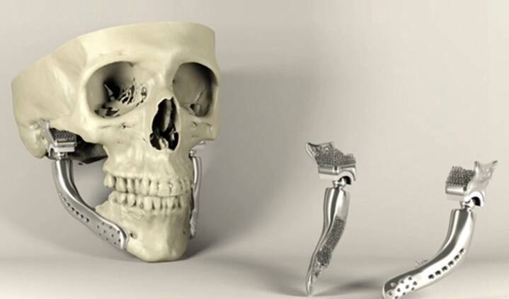 倫敦大學(xué)新研究：DIW 3D打印生物活性骨植入物展現(xiàn)良好特性