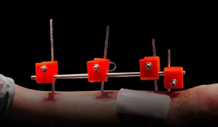 加沙醫(yī)生利用3D打印技術(shù)制造出世界上第一個外固定器