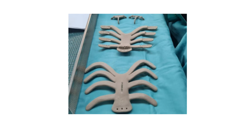 克拉利特-贝林森医院使用3D打印PEKK植入物为患者重建胸壁