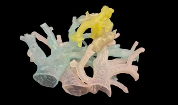 医生利用3D打印肺血管模型为患者“定制”导管，成功完成复杂介入手术