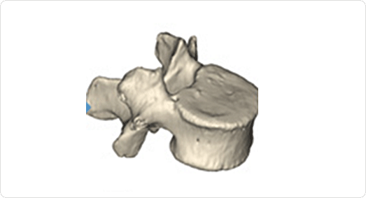 3d打印椎骨完成模拟手术