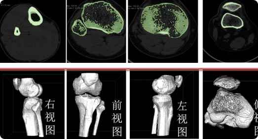 ct掃描髕骨,進行dicom數據分析